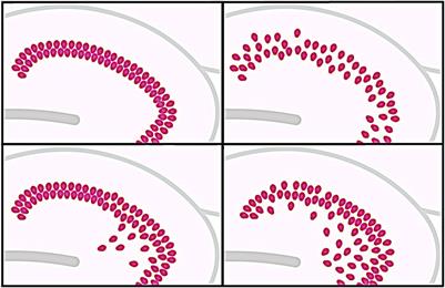 Considering the Role of Extracellular Matrix Molecules, in Particular Reelin, in Granule Cell Dispersion Related to Temporal Lobe Epilepsy